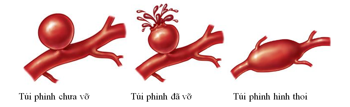 Hình ảnh minh họa sự phát triển và thay đổi kích thước của phình động mạch não theo thời gian