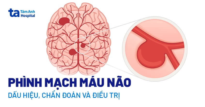Hình ảnh minh họa các biến chứng thần kinh có thể xảy ra sau can thiệp phình động mạch não