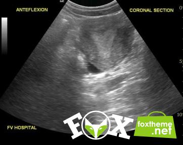 Báo cáo ca bệnh song thai IVF trên tử cung chột và tử cung một sừng, biến chứng vỡ ở tử cung chột chưa thai Báo cáo ca bệnh song thai IVF trên tử cung chột và tử cung một sừng, biến chứng vỡ ở tử cung chột chưa thai