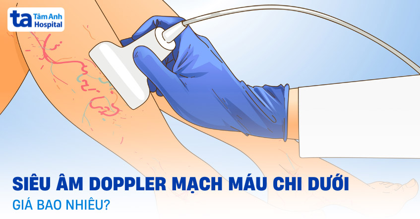 Hình ảnh siêu âm Doppler cho thấy hẹp động mạch chi dưới