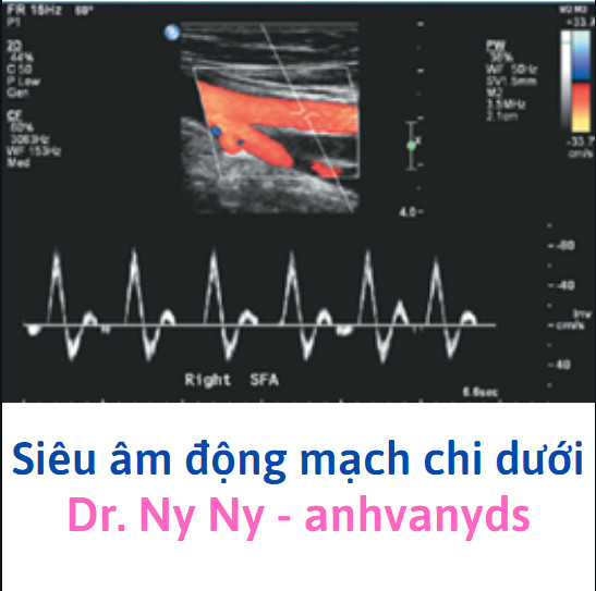 Hình ảnh Doppler phổ cho thấy dạng sóng ba pha bình thường ở động mạch chi dưới
