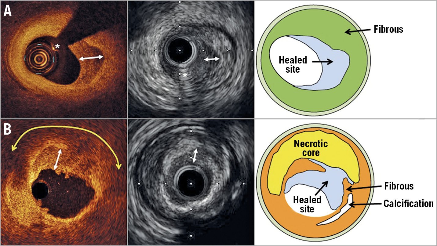 Hình ảnh IVUS của mảng xơ vữa trong động mạch vành