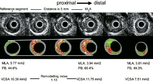 Remodeling Index và Plaque Burden trên hình ảnh IVUS