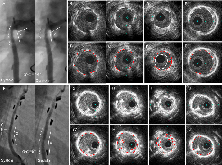 Hình ảnh IVUS cho thấy tái hẹp trong stent sau can thiệp mạch vành qua da