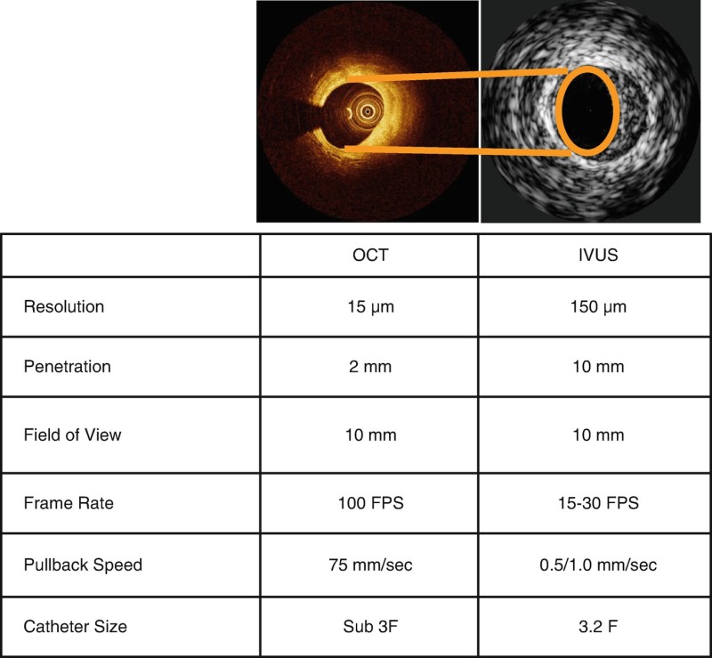 So sánh hình ảnh OCT và IVUS trong đánh giá mảng xơ vữa