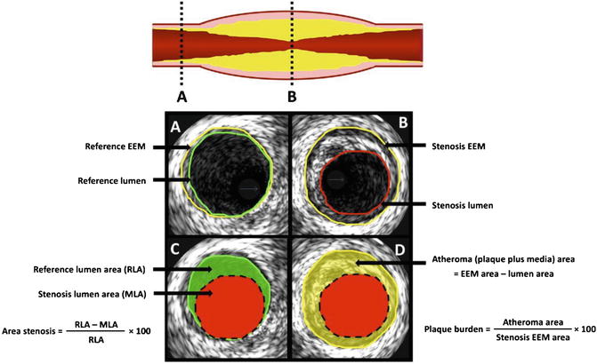 Đo diện tích mảng xơ vữa Plaque Area trên hình ảnh IVUS