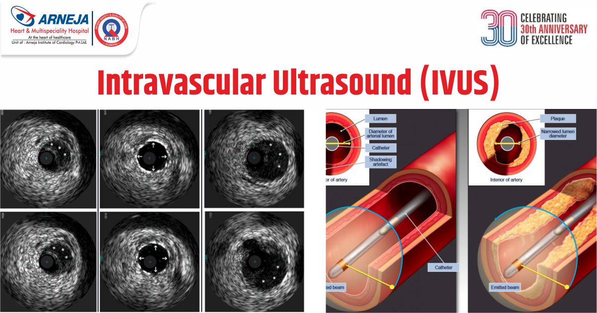 Đầu dò IVUS bên trong động mạch vành