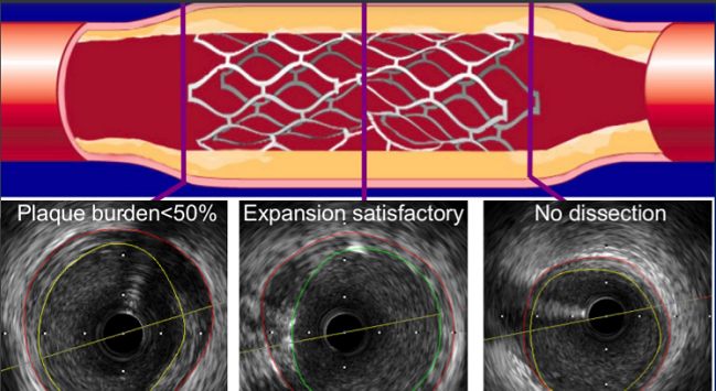 Hình ảnh IVUS sau khi đặt stent đánh giá mức độ áp sát stent và diện tích lòng mạch