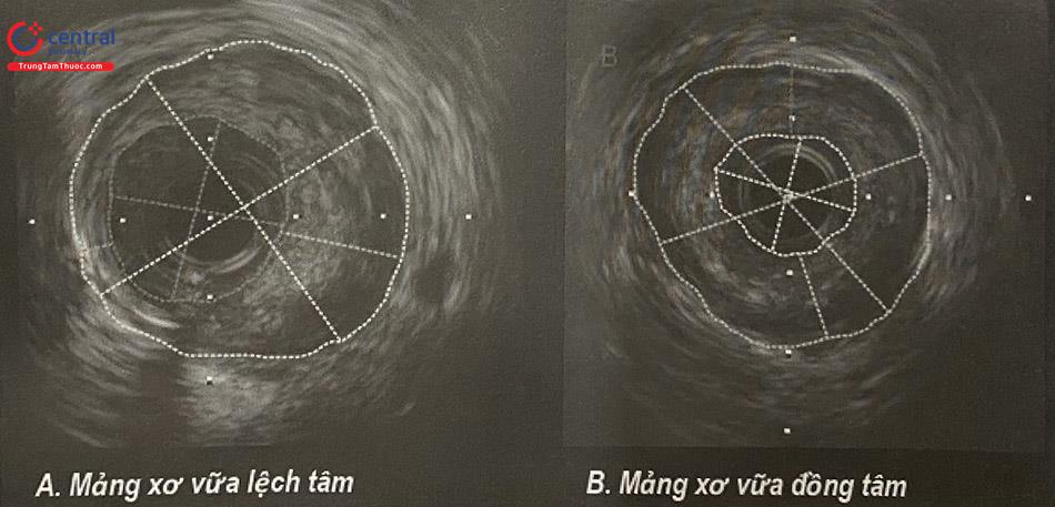 Hình ảnh IVUS cho thấy mảng xơ vữa có nhân lipid lớn và màng xơ mỏng TCFA