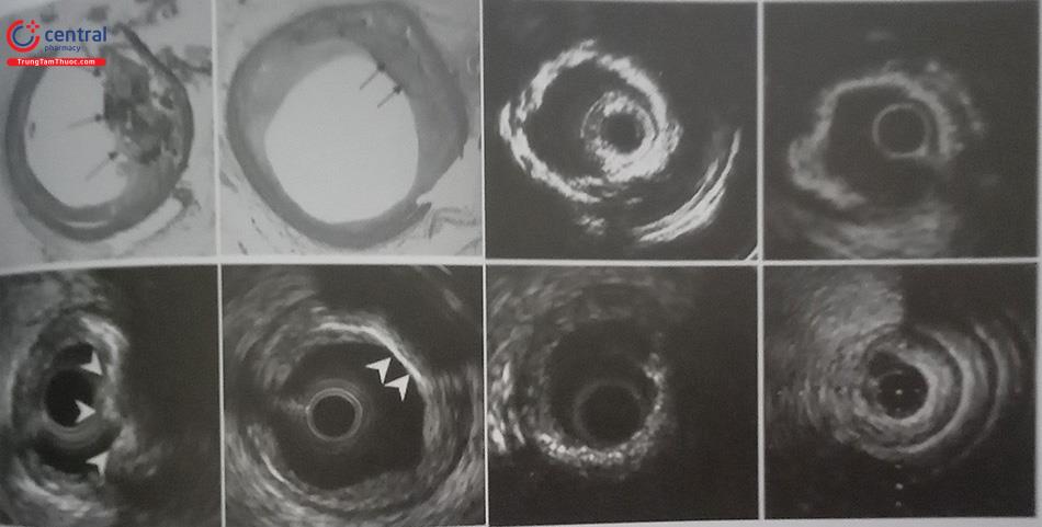 Hình ảnh IVUS cho thấy mảng vôi hóa lớn trong động mạch vành với bóng lưng rõ rệt