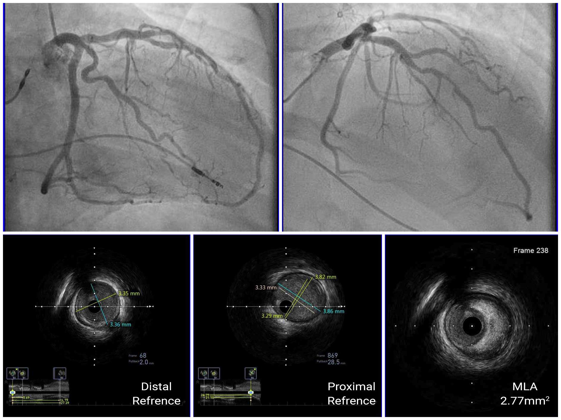Hình ảnh IVUS minh họa việc lựa chọn kích thước stent