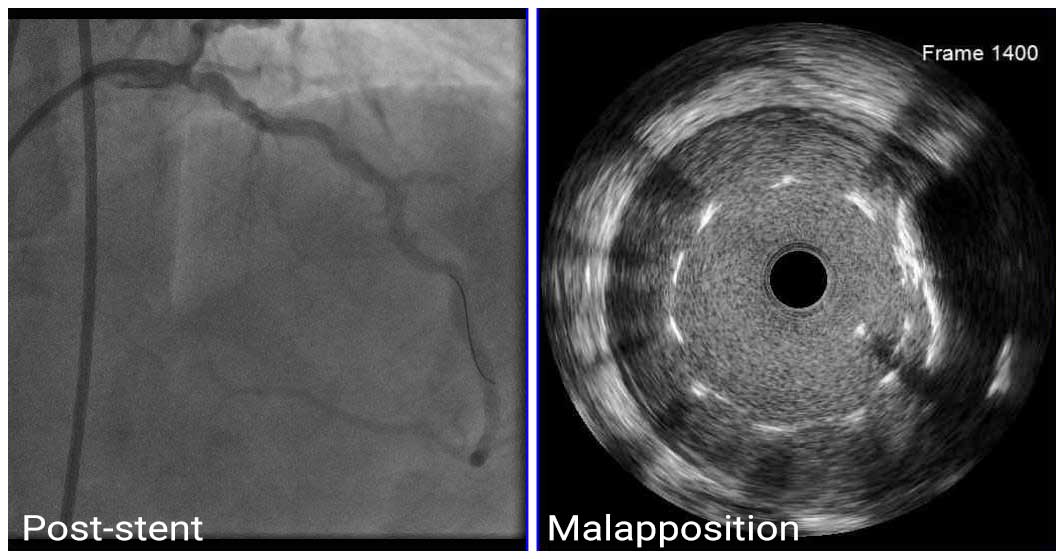 Hình ảnh IVUS cho thấy tình trạng stent không áp sát sau can thiệp mạch vành qua da