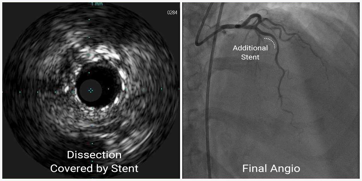 Hình ảnh IVUS minh họa bóc tách thành mạch sau PCI