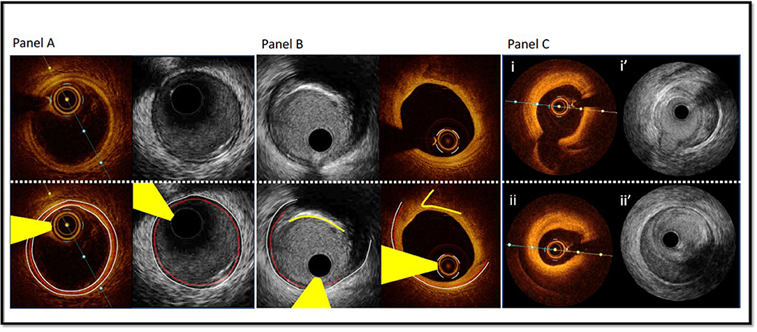 Sơ đồ thiết kế nghiên cứu lâm sàng ngẫu nhiên có đối chứng so sánh IVUS và PCI