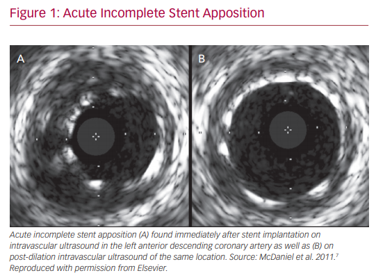 Hình ảnh IVUS minh họa sự áp sát của stent vào thành mạch