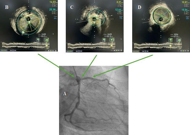 Hình ảnh IVUS cho thấy cách đo chiều dài tổn thương động mạch vành để lựa chọn kích thước stent phù hợp