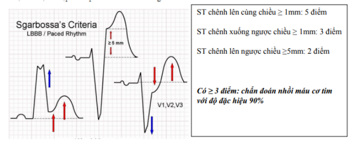 Điện tâm đồ điển hình của nhồi máu cơ tim ST chênh lên STEMI